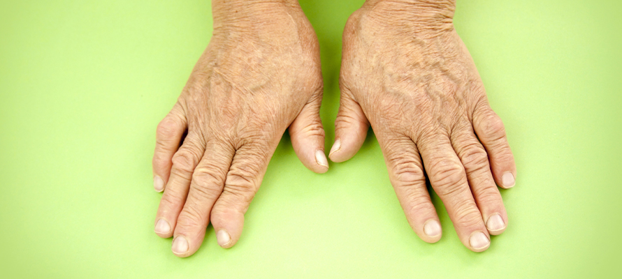 Home Remedies Rheumatoid Arthritis