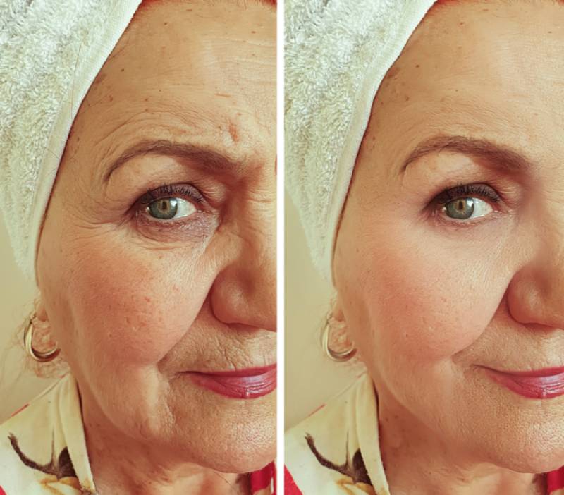 Stemuderm Before After (1)