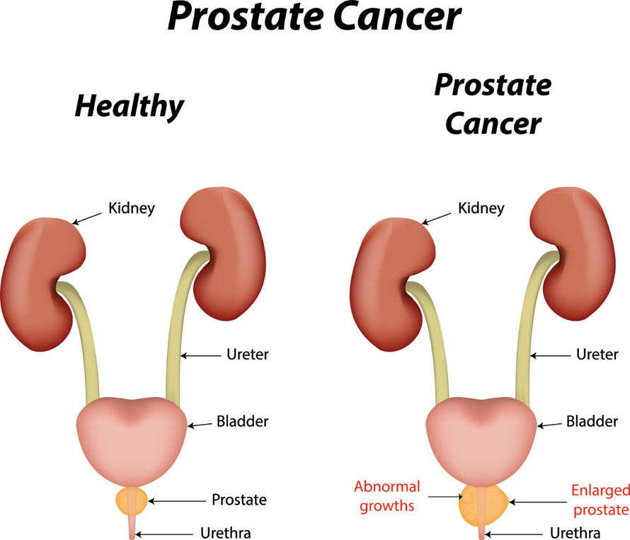 Spread of Prostate Cancer
