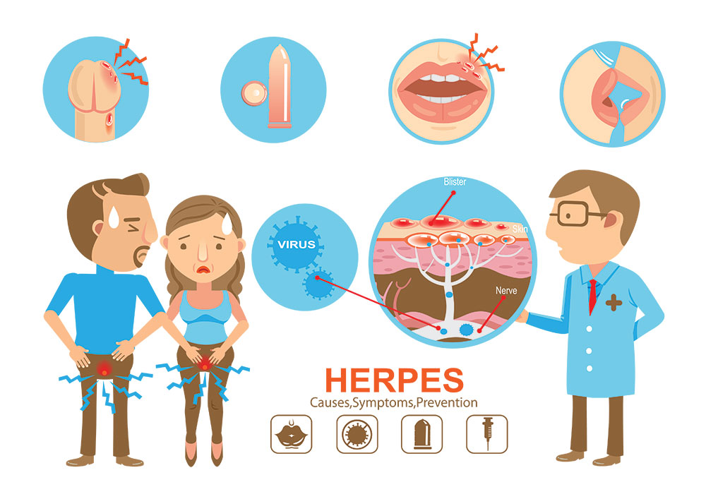 Genital Herpes