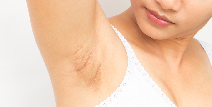 Dark Underarms