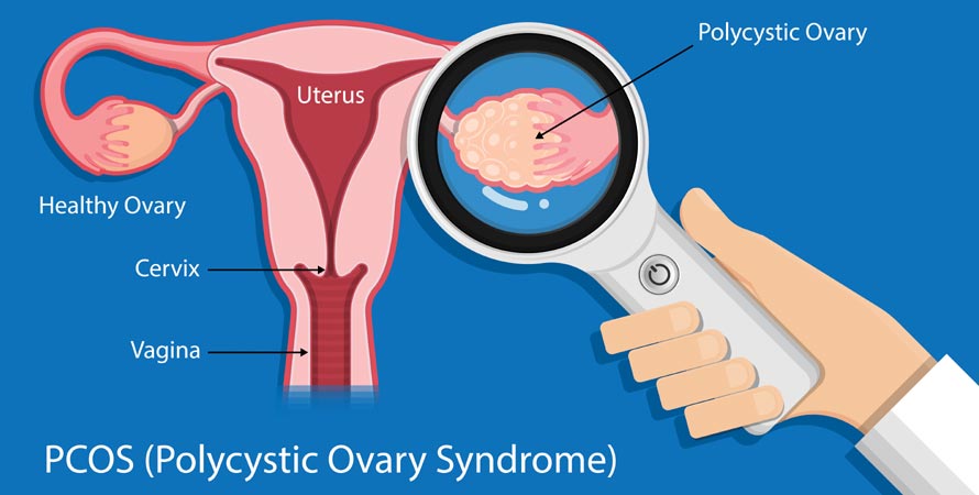 Polycystic ovary syndrome