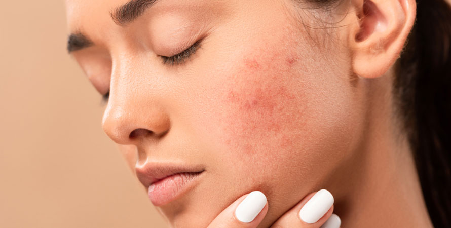 Acne Skin
