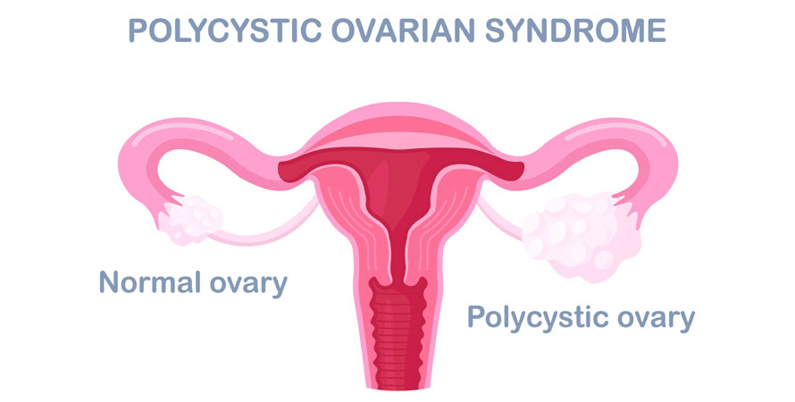Polycystic Ovary Syndrome