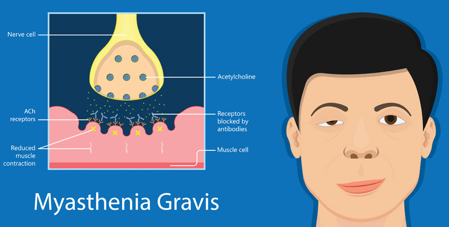 Myasthenia Gravis Formation