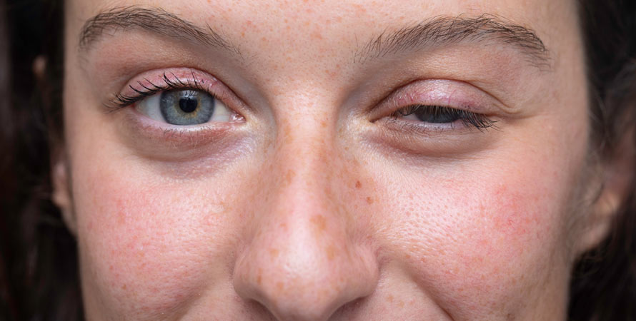 Symptoms Of MG