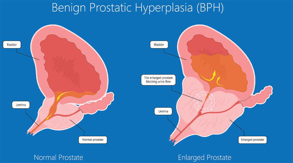 Prostatitis condition