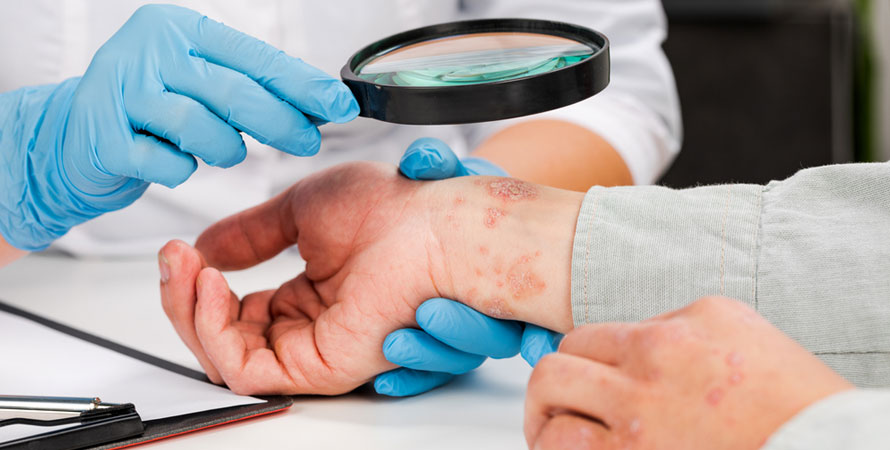 Skin disorders