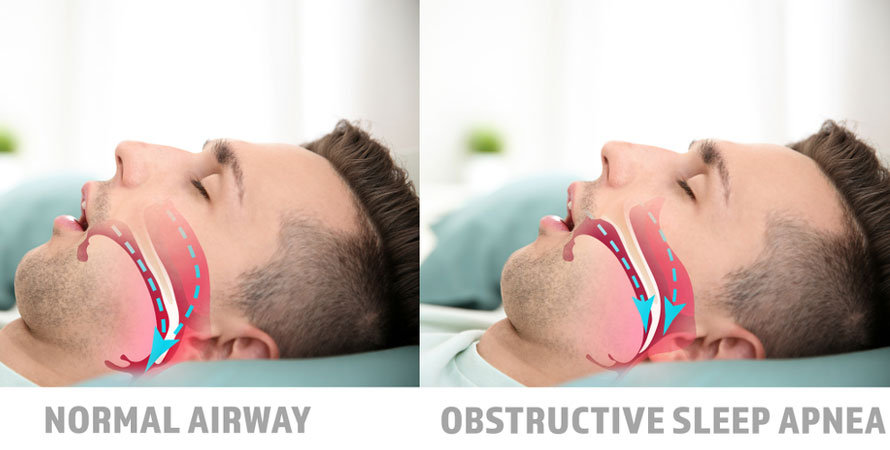 Sleep Apnea Affect Your Body