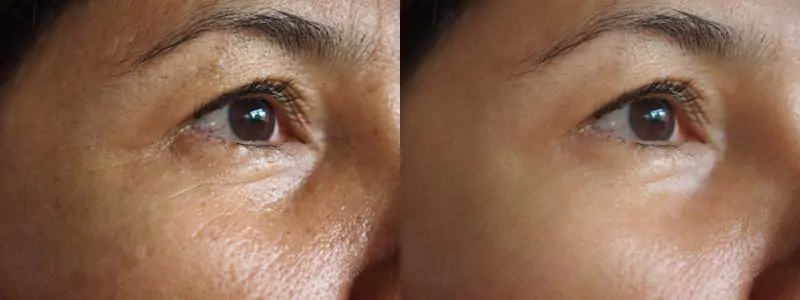 eyes-before-after