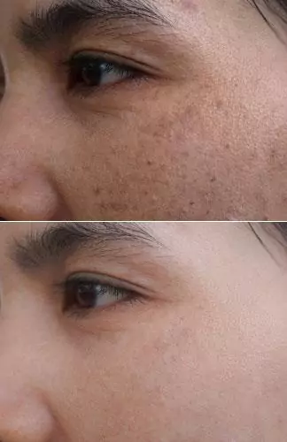 before-after