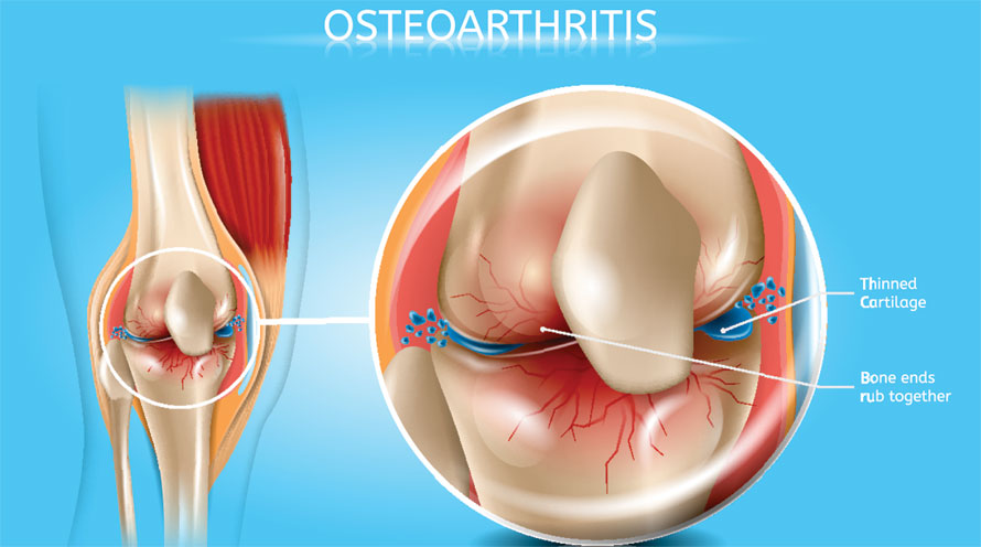 Osteoarthritis