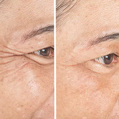 eyes-before-after
