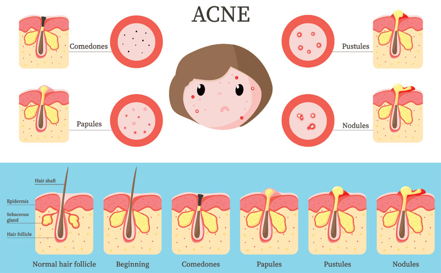 Acne type