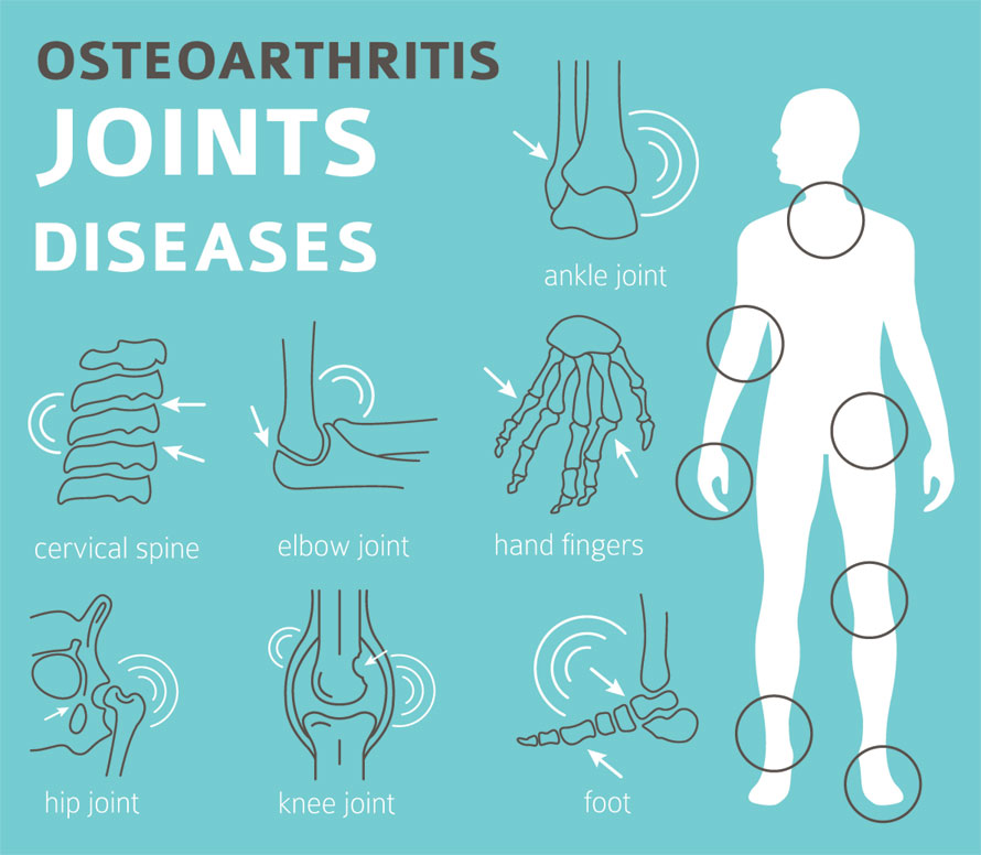 Osteoarthritis Joints