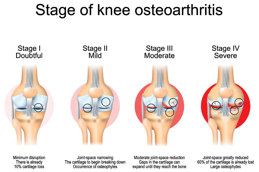 Knee Osteoarthritis