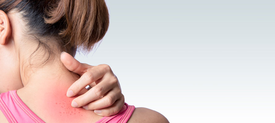 Heat Rash vs Sun Poisoning
