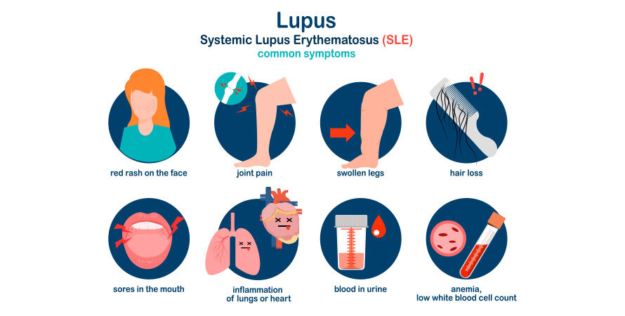 Does Lupus Cause Joint Pain? Autoimmune Inflammation and Joint Damage