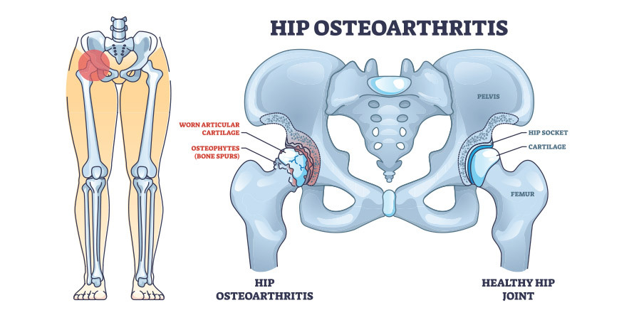 Hip Joint Pain When Walking – Osteoarthritis Cartilage Degeneration