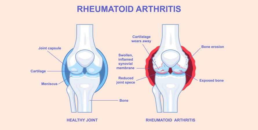 Does Menopause Cause Joint Pain? Rheumatoid Arthritis and Inflammation