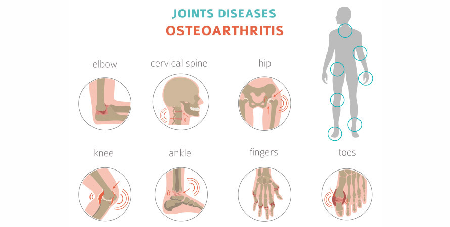 How to Stop Joint Pain When It Rains – Osteoarthritis and Weather-Related Joint Discomfort