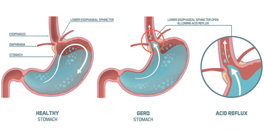Acid reflux and GERD Causes