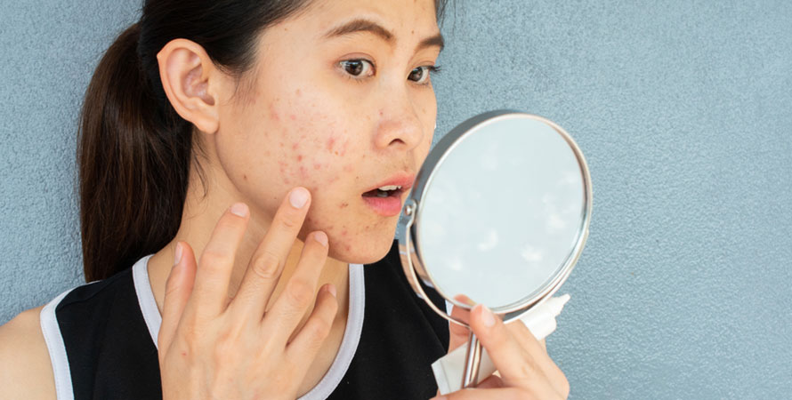 Acne Scars Develop