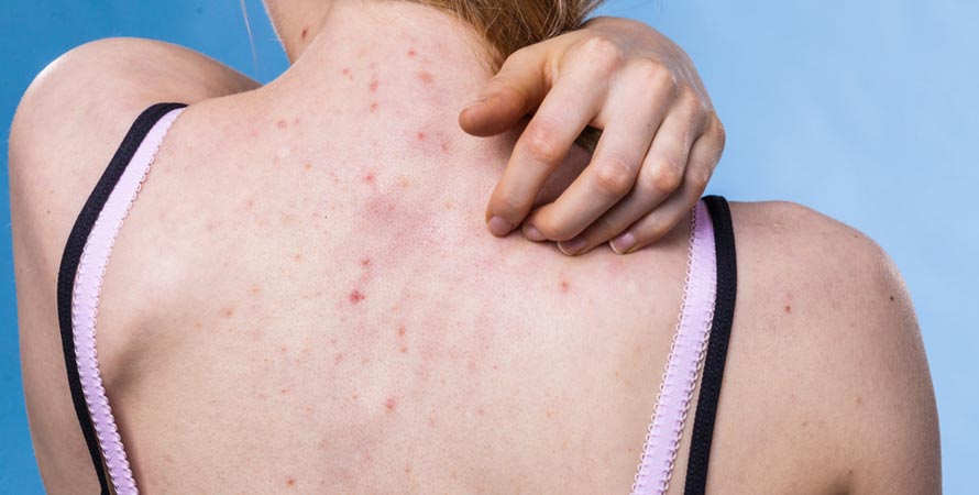 Causes Back Acne