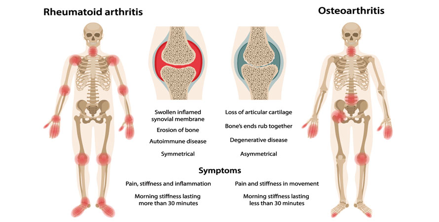 Rheumatoid Arthritis vs Osteoarthritis: Key Comparisons