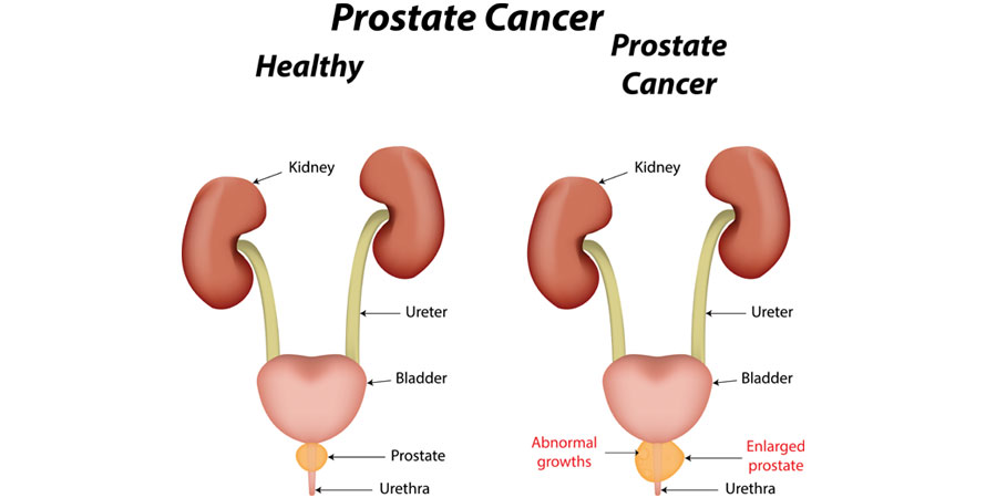 Explaining Prostate Cancer