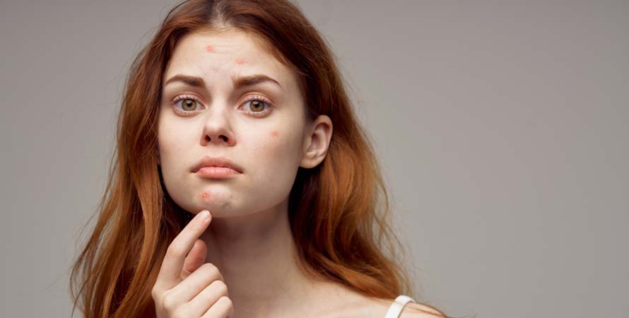Get Rid of Pimples