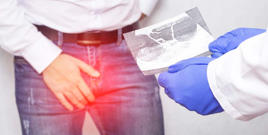 Hypogonadism in men - low testosterone