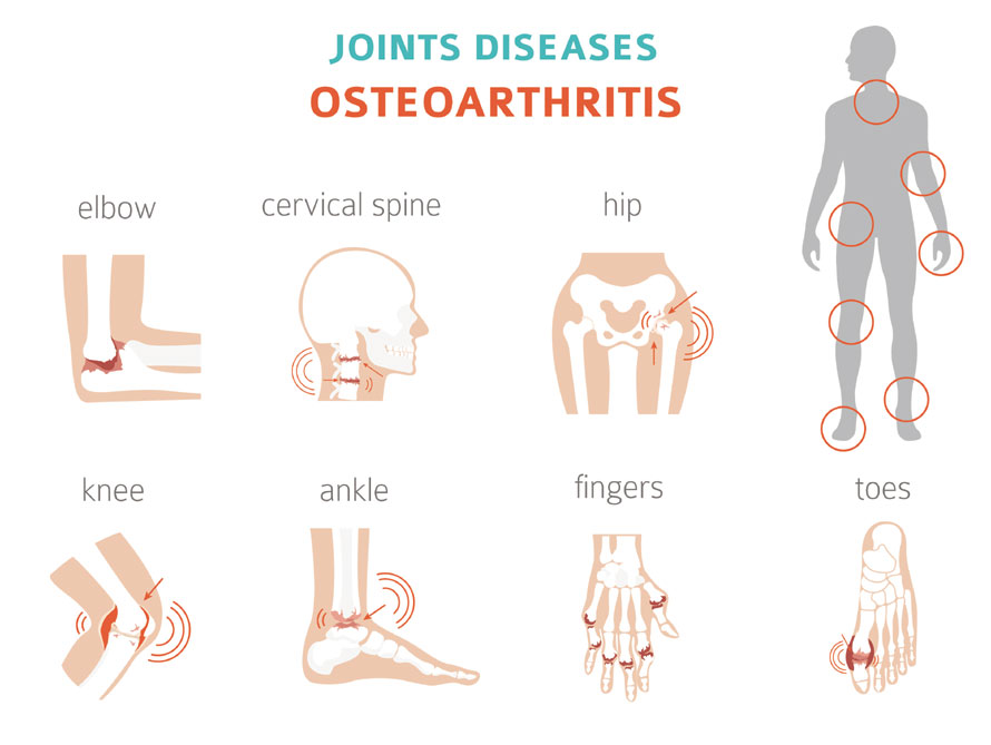 Osteoarthritis Info