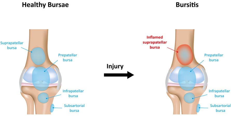 What Is Bursitis
